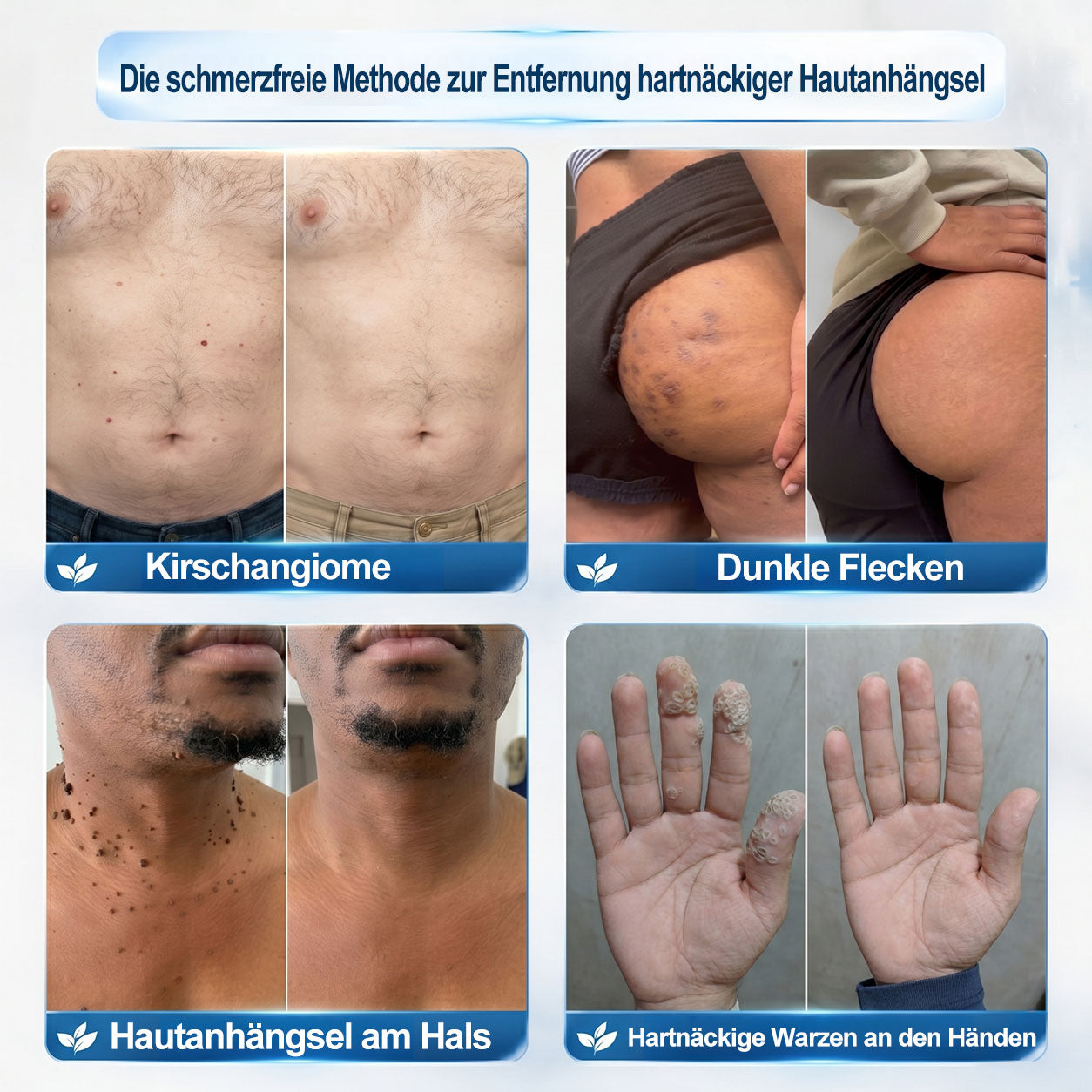 ✨🎇Offizieller Markenstore |✅𝑷𝑖𝒄𝐝𝐨® 7-𝑻𝒂𝒈𝒆 𝑯𝒂𝒖𝒕𝒂𝒏𝒉ä𝒏𝒈𝒔𝒆𝒍- & 𝑭𝒍𝒆𝒄𝒌𝒆𝒏𝒆𝒏𝒕𝒇𝒆𝒓𝒏𝒆𝒓(Schmerzfreier Rollerball – Keine Narbenbildung)🚀