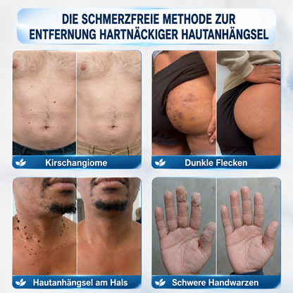 💧💧 𝑶𝒇𝒇𝒊𝒛𝒊𝒆𝒍𝒍𝒆𝒓 𝑺𝒕𝒐𝒓𝒆 | 𝑵𝐞𝒌𝐢𝐬𝐬® 🌿 𝑴𝒊𝒌𝒓𝒐𝒏𝒂𝒅𝒆𝒍𝒏 𝑴𝒂𝒌𝒆𝒍𝒍𝒐𝒔𝒆 𝑯𝒂𝒖𝒕 𝑯𝒂𝒖𝒕 𝑾𝒂𝒓𝒛𝒆 𝑬𝒏𝒕𝒇𝒆𝒓𝒏𝒖𝒏𝒈 𝑷𝒇𝒍𝒂𝒔𝒕𝒆𝒓 (𝐹ü𝑟 𝐻𝑎𝑢𝑡𝑎𝑛ℎä𝑛𝑔𝑠𝑒𝑙, 𝑘𝑙𝑒𝑖𝑛𝑒 𝐻𝑎𝑢𝑡𝑤𝑢𝑐ℎ𝑒𝑟𝑢𝑛𝑔𝑒𝑛, 𝑊𝑎𝑟𝑧𝑒𝑛, 𝑀𝑢𝑡𝑡𝑒𝑟𝑚𝑎𝑙𝑒, 𝐴𝑙𝑡𝑒𝑟𝑠𝑓𝑙𝑒𝑐𝑘𝑒𝑛 𝑢𝑛𝑑 𝑃𝑖𝑔𝑚𝑒𝑛𝑡𝑠𝑡ö𝑟𝑢𝑛𝑔𝑒𝑛.)